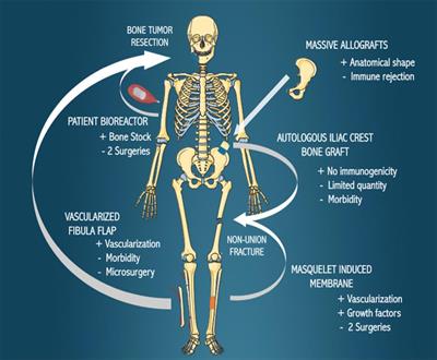 Reconstruction of Large Skeletal Defects: Current Clinical Therapeutic Strategies and Future Directions Using 3D Printing